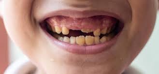 Γιατί τα μόνιμα δόντια του παιδιού μου είναι κίτρινα; Είναι ανησυχητικό;